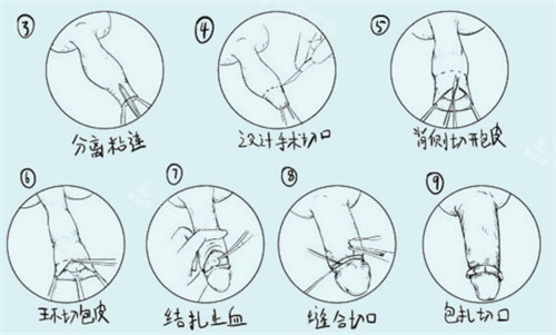 割包皮手术过程.jpg