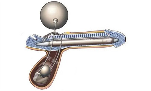 阴茎植入.jpg