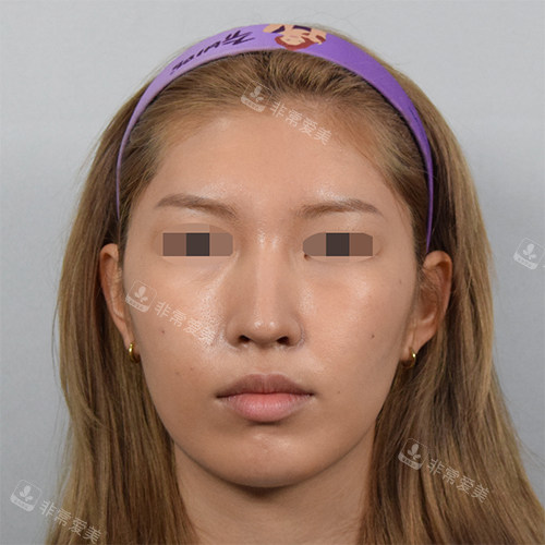 韩国EG童颜整形皮肤科面部填充前照片