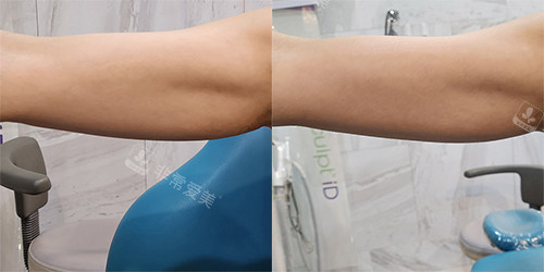 韩国EG童颜整形手臂脂肪分解手术前后对比