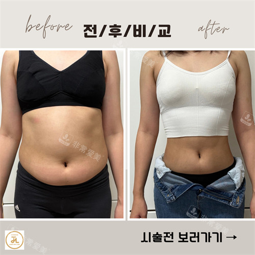 韩国清潭JASMINE LINE CLINIC的一日瘦身套餐前后对比图