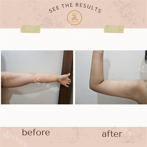 韩国清潭JASMINE LINE CLINIC手臂脂肪管理前后对比图