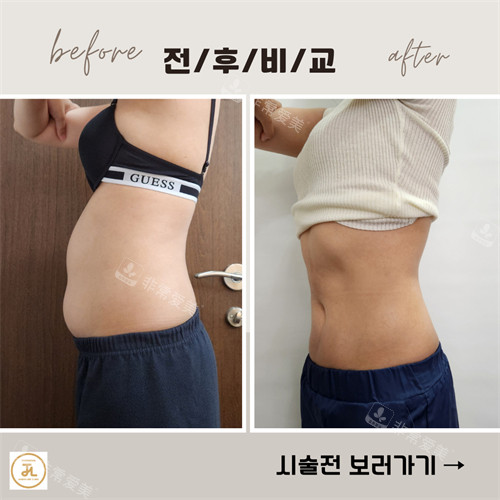 韩国清潭JASMINE LINE CLINIC家一日瘦身套餐瘦腰腹前后对比图