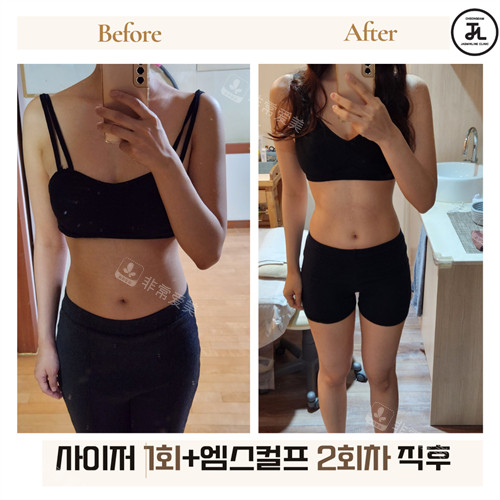 韩国清潭jasmine line clinic腰部塑形对比