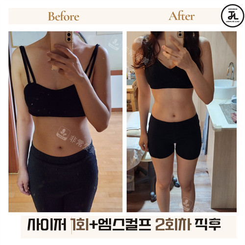 韓國清潭jasmine line clinic腰部塑形對比 韓國清潭jasmine line clinic腰部塑形對比