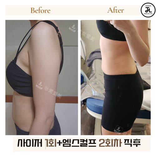 3韩国清潭jasmine line clinic腰部塑形前后图