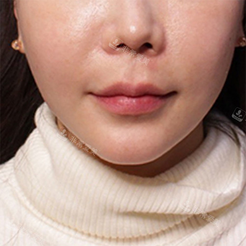 韩国EG童颜整形瘦脸后图片