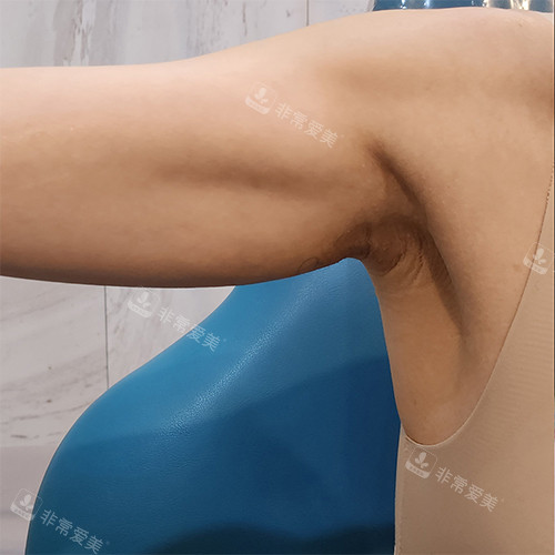 韩国EG童颜整形手臂高周波管理后图片