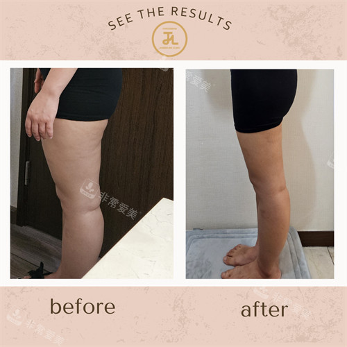 韓國(guó)清潭jasmine line clinic腿部塑形前后圖