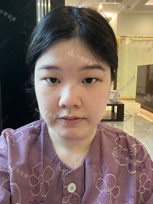 韓國VG整形外科術前正面照