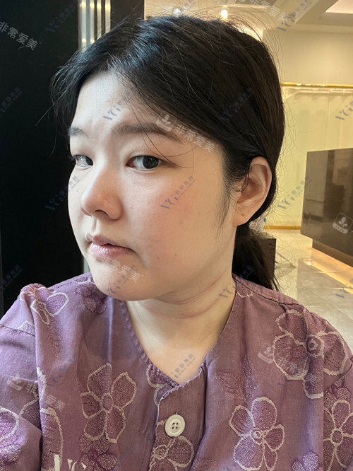 韓國VG整形外科術前45°照