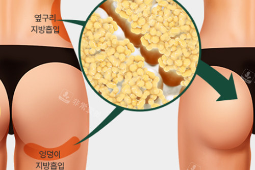 自體脂肪豐臀前后對(duì)比圖