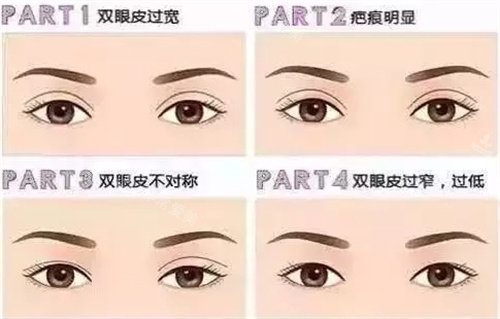 双眼皮修复的四种情况