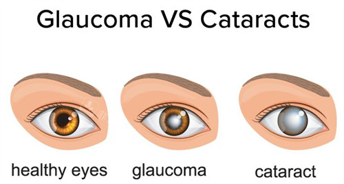 健康眼睛和青光眼的区别