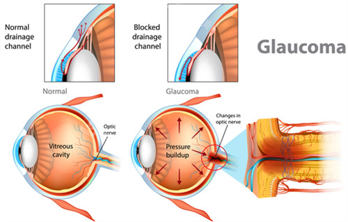 青光眼和健康眼睛区别