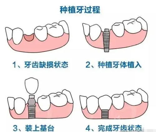 种植牙过程示意图