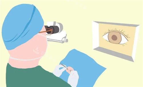 近视眼手术过程科通图