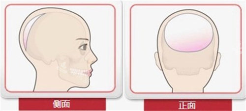 后脑勺整形手术