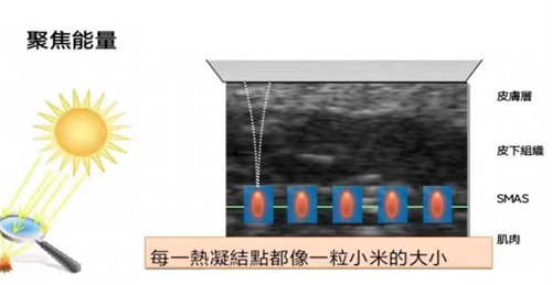 超声王单点释能