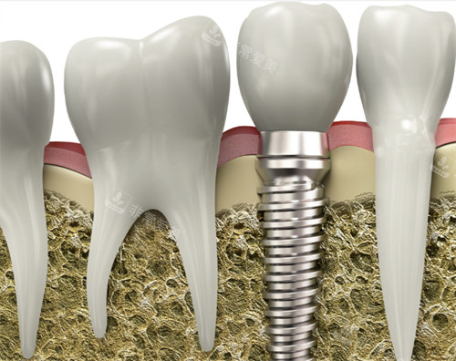 种植牙和正常牙齿的区别图解