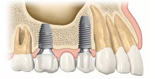 种植牙动画图