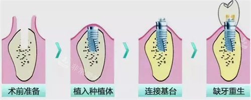 種植牙流程圖