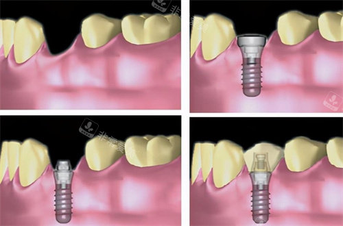 种植牙演示图