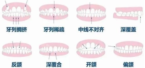 各种牙齿畸形示意图