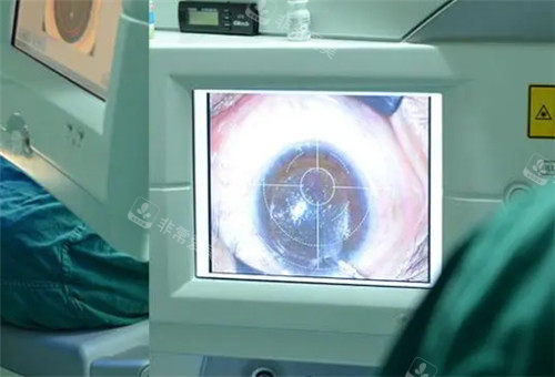 近视眼手术图
