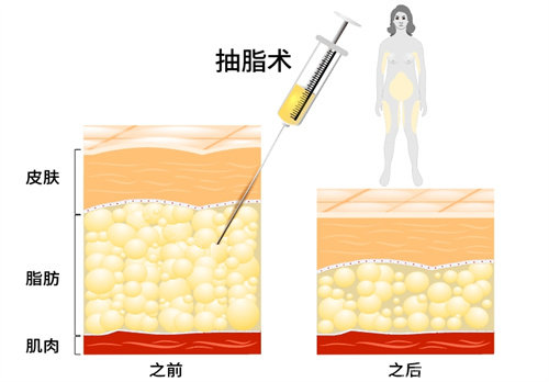 抽脂前后对比图