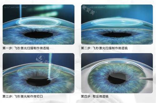 全飞秒手术示意图