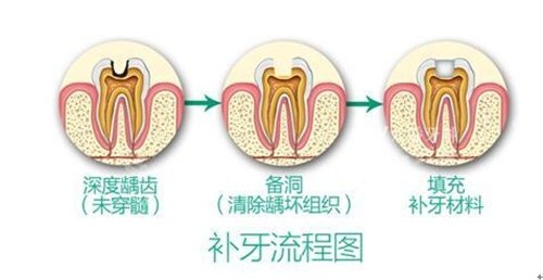 补牙过程图