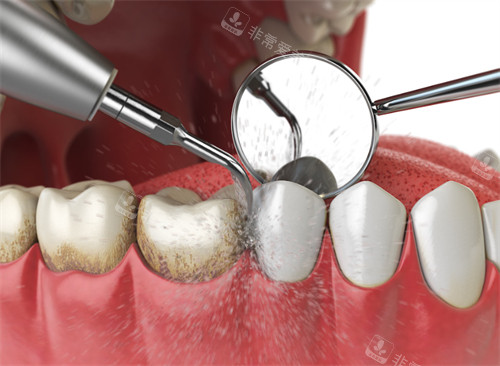 洁牙手术清洁牙齿上的牙结石
