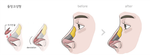 隆鼻手术前后对比