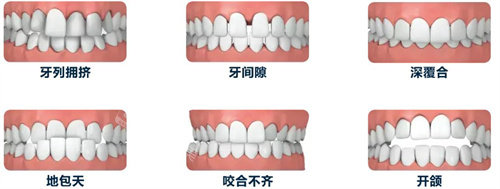 牙齿排列问题图