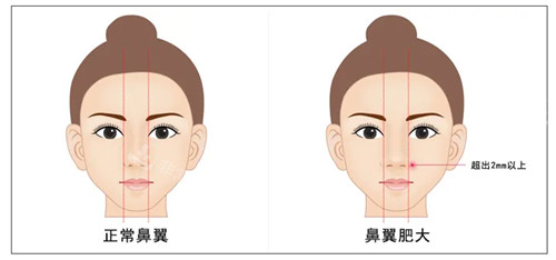 鼻翼縮小動畫圖示 鼻翼縮小動畫圖示