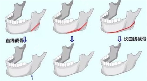 杭州唐冬生做下颌角怎么样?超长曲线截骨轮廓更好看!
