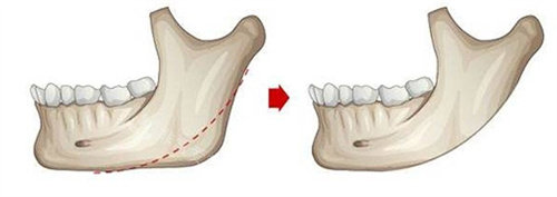 下颌角截骨动画图