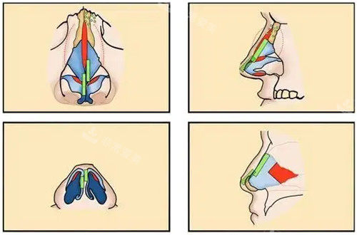 鼻部解剖手术图