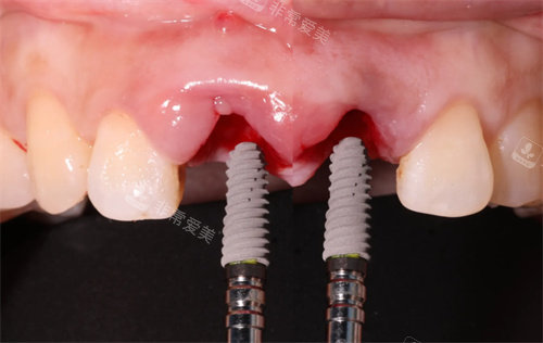 种植牙手术过程图 (2)
