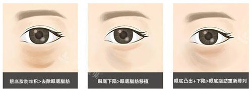 眼底脂肪重排對比 眼底脂肪重排對比