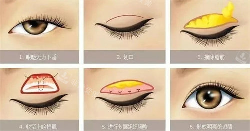 雙眼皮手術(shù)流程圖 雙眼皮手術(shù)流程圖