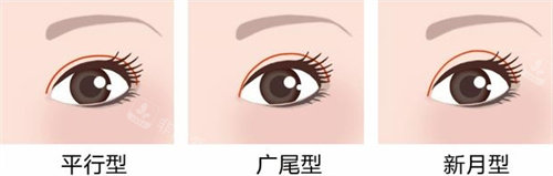 三種不同雙眼皮形狀圖 三種不同雙眼皮形狀圖