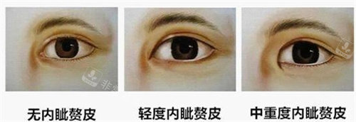 內(nèi)眥贅皮動(dòng)畫圖 內(nèi)眥贅皮動(dòng)畫圖