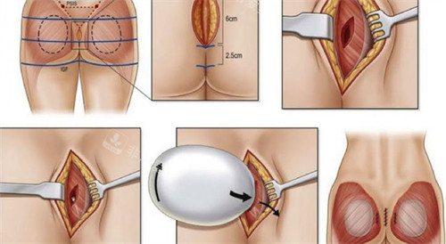 假体丰臀手术过程