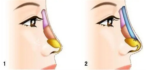 隆鼻结构图