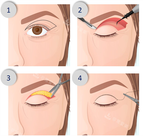 双眼皮手术流程