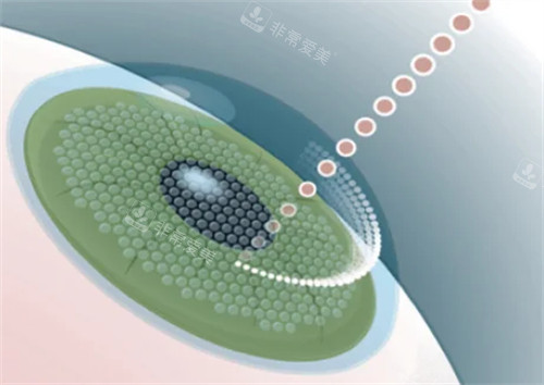 飞秒激光近视手术过程图解