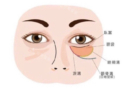 填泪沟用什么方法好?玻尿酸/自体脂肪/胶原蛋白/假体哪个好?