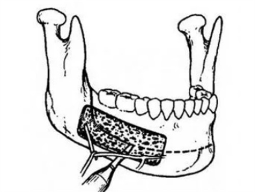 下颌前部根尖下截骨术过程图解